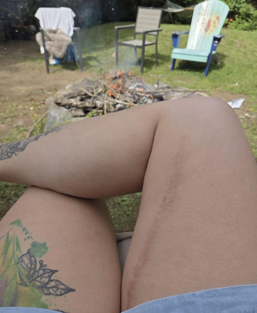 chirurgie réparatrice cuisse